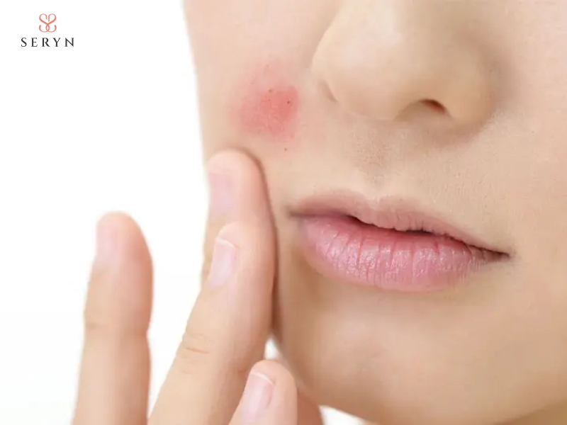 Tiêm filler có thể gây sưng, bầm tím hoặc biến chứng nghiêm trọng Tiêm filler có thể gây sưng, bầm tím hoặc biến chứng nghiêm trọng