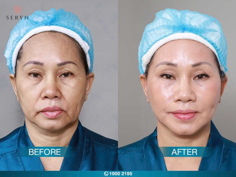 Filler HA thường duy trì hiệu quả làm đầy má hóp khoảng 6 đến 18 tháng Filler HA thường duy trì hiệu quả làm đầy má hóp khoảng 6 đến 18 tháng