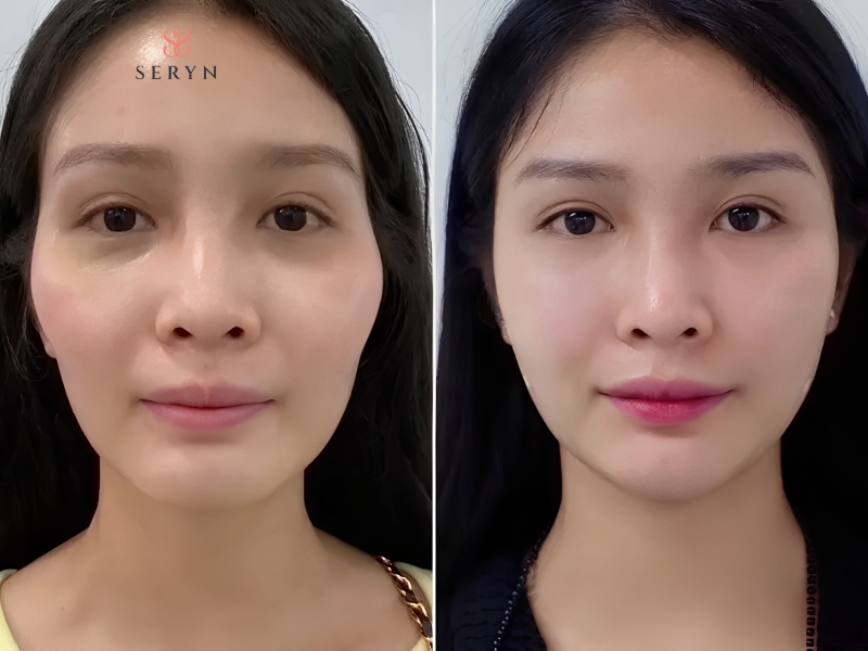 Cấy mỡ tự thân có thể bổ sung thể tích cho vùng má hóp khi có chỉ định phù hợp Cấy mỡ tự thân có thể bổ sung thể tích cho vùng má hóp khi có chỉ định phù hợp