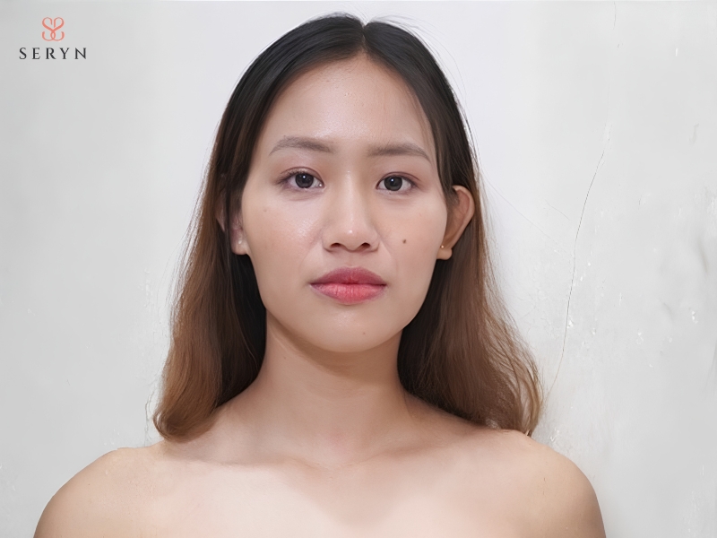 Má hóp sâu có thể đi kèm da chảy xệ và hõm ở vùng thái dương Má hóp sâu có thể đi kèm da chảy xệ và hõm ở vùng thái dương