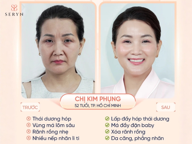 Cải thiện má bị hóp hiệu quả tại SERYN Cải thiện má bị hóp hiệu quả tại SERYN