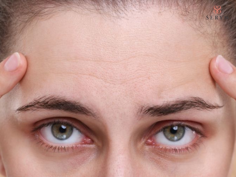 Nhăn trán là những đường hằn xuất hiện trên da trán khi cơ trán co lại và kéo da Nhăn trán là những đường hằn xuất hiện trên da trán khi cơ trán co lại và kéo da