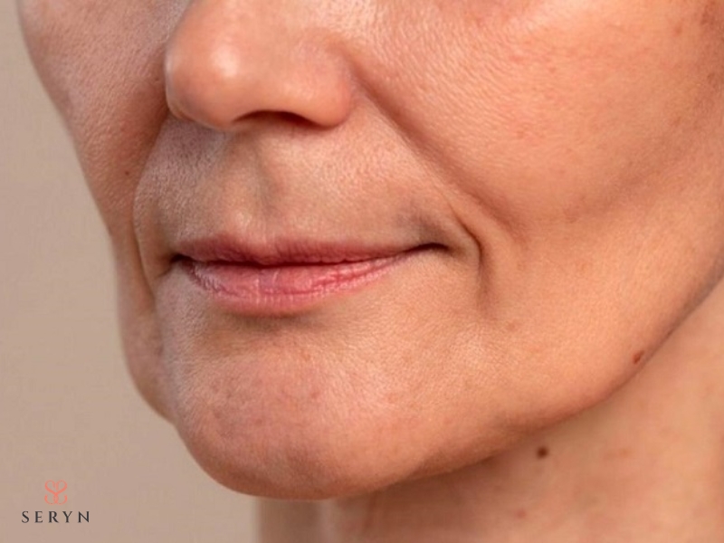 Rãnh cười sâu thường đi kèm chảy xệ và nếp gấp quanh miệng Rãnh cười sâu thường đi kèm chảy xệ và nếp gấp quanh miệng