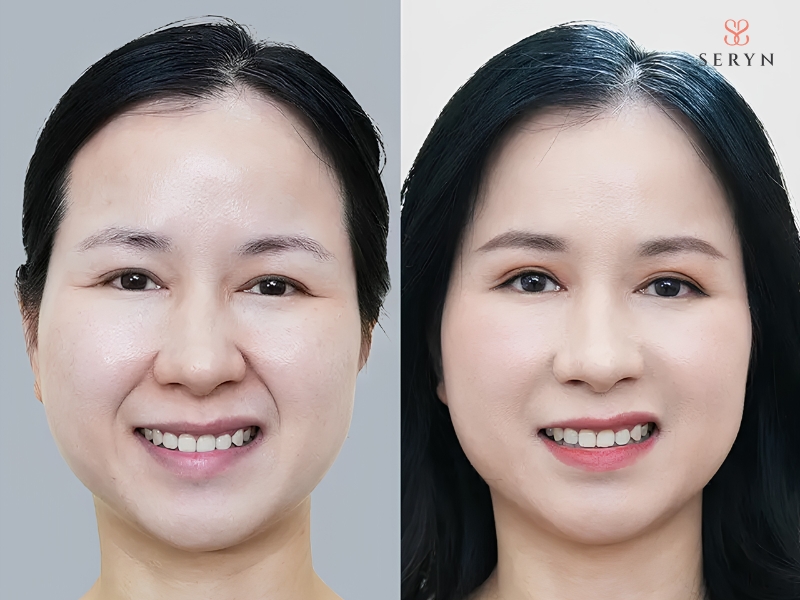 Kết quả xóa rãnh cười duy trì được lên tới 18 tháng Kết quả xóa rãnh cười duy trì được lên tới 18 tháng