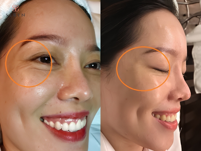 Hiệu quả Botox vùng mắt thường rõ dần trong khoảng hai tuần và giảm theo thời gian Hiệu quả Botox vùng mắt thường rõ dần trong khoảng hai tuần và giảm theo thời gian