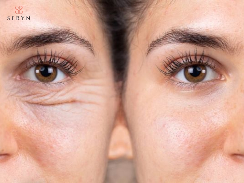 Botox thường được cân nhắc cho người có nếp chân chim rõ khi cười hoặc nheo mắt. Botox thường được cân nhắc cho người có nếp chân chim rõ khi cười hoặc nheo mắt.