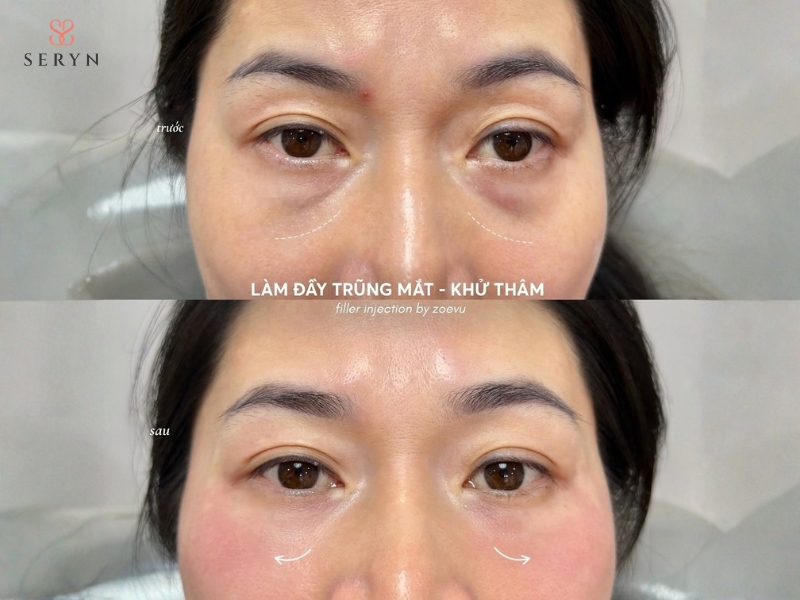 Filler có thể tạo hiệu ứng làm đầy ngay sau tiêm và duy trì trong nhiều tháng Filler có thể tạo hiệu ứng làm đầy ngay sau tiêm và duy trì trong nhiều tháng
