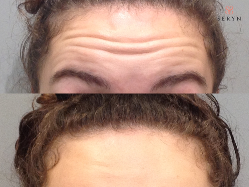 Hiệu quả Botox thay đổi theo từng giai đoạn và duy trì ổn định trong khoảng 3-4 tháng Hiệu quả Botox thay đổi theo từng giai đoạn và duy trì ổn định trong khoảng 3-4 tháng