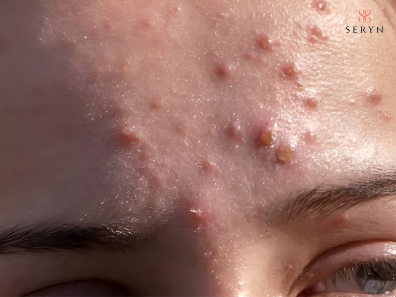 Vùng da viêm nhiễm cần tránh hoặc thận trọng khi tiêm Botox Vùng da viêm nhiễm cần tránh hoặc thận trọng khi tiêm Botox