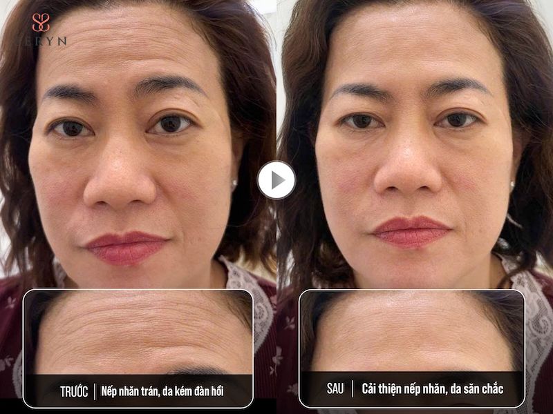 Hiệu quả filler xóa nhăn trán thường duy trì khoảng 6 đến 12 tháng. Hiệu quả filler xóa nhăn trán thường duy trì khoảng 6 đến 12 tháng.