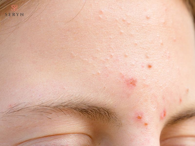 Tiêm filler sai kỹ thuật có thể gây sưng, bầm tím nhẹ, đỏ da Tiêm filler sai kỹ thuật có thể gây sưng, bầm tím nhẹ, đỏ da
