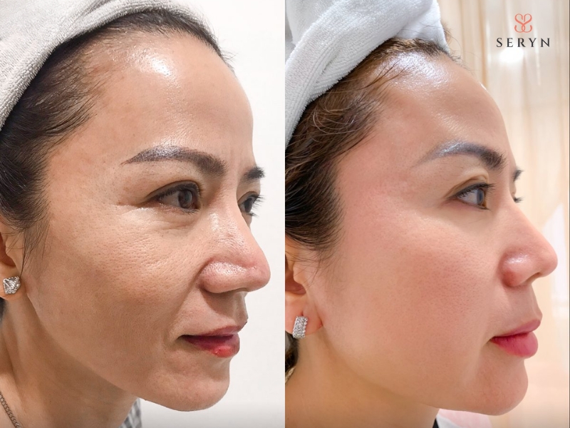 Hiệu quả filler rãnh cười thay đổi theo thời gian từ sau tiêm đến khi ổn định Hiệu quả filler rãnh cười thay đổi theo thời gian từ sau tiêm đến khi ổn định