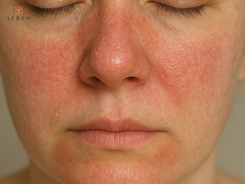 Tiêm Botox vùng mắt vẫn có thể gây bầm, sưng hoặc sụp mí nếu thực hiện không đúng kỹ thuật Tiêm Botox vùng mắt vẫn có thể gây bầm, sưng hoặc sụp mí nếu thực hiện không đúng kỹ thuật
