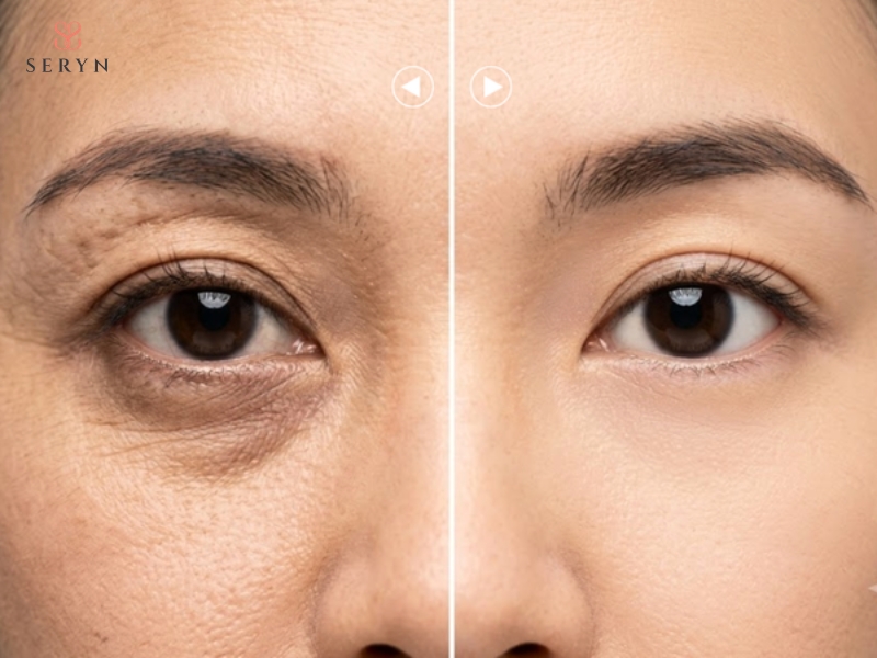 Baby botox hướng đến cải thiện nếp nhăn mà vẫn giữ biểu cảm tự nhiên Baby botox hướng đến cải thiện nếp nhăn mà vẫn giữ biểu cảm tự nhiên